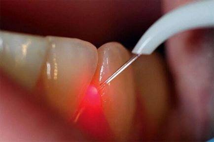 Tratament virusul hpv bucal Condiloame ale gingiilor