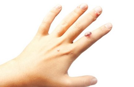 papilomele plate pe tratamentul mâinilor