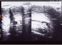 Tratamentul patogenetic al inducției penile fibroplastice (boala Peyronie), experimentală