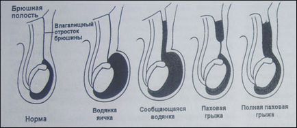 Hernia inghinala si edemul cojilor de testicule, Yuri Yudvartovich Rudin