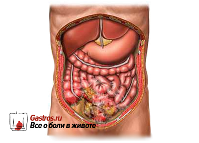 Peritonita simptome intestinale, tratament, clasificare