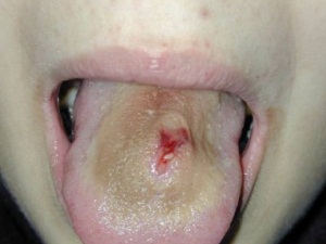 Piercing az ajkak és a nyelv vezet fogvesztés