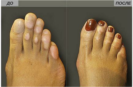 Пластика пальців ніг результат до і після, ніж особлива пластика великого пальця ноги