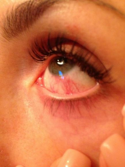 De ce ochii roșii după extensia genelor și răniți ce să faceți și ce să picurăți