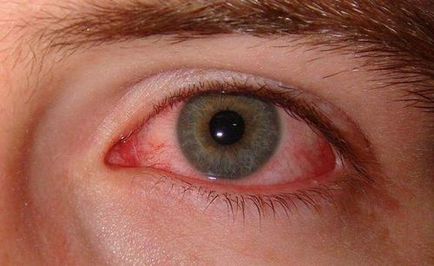 Чому червоні очі після нарощування вій та болять що робити і чим капати