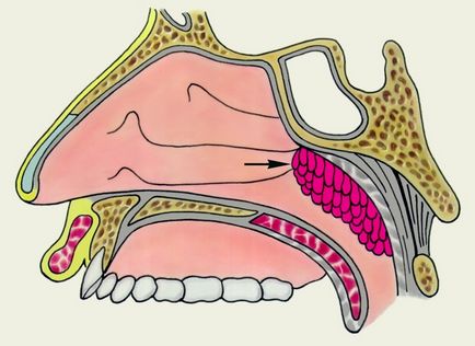 A posztoperatív időszakban a gyermekek után adenoidectomy, torokfájás