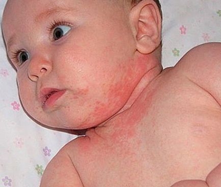 Inflamația la nou-născuți arată și cum să scapi de erupția pe față și gât