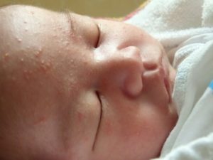 Transpirația în bebeluși foto, simptome și tratament