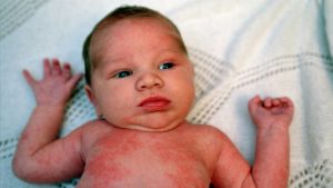 Malária kiütés, a gyermek fotó, tünetei és kezelése