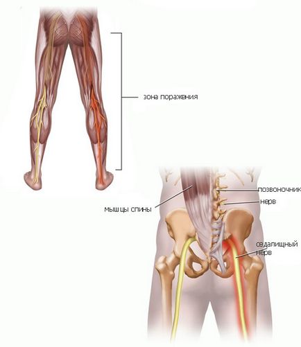 Cauzele și tratamentul sciatică