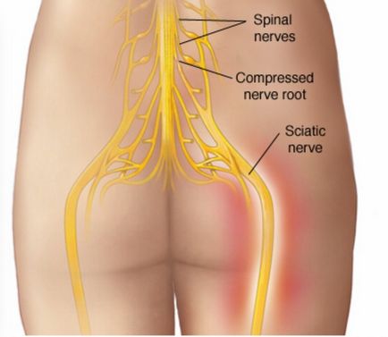 Cauzele și tratamentul sciatică