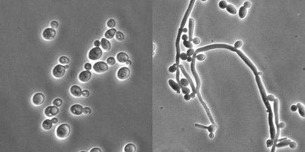 Az okok a gombás fertőzése férfiak - miért candidiasis alakul, és hogyan kell védekezni ellene
