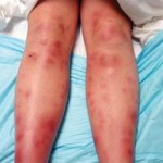 Az okok a erythema nodosum a lábakon (az ok) Az okok a erythema nodosum a lábakon