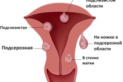 Cauzele întârzierii la menstruație, altele decât sarcina