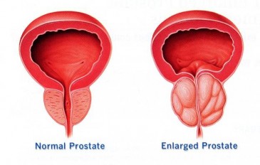 Prostatitele provoacă, simptome, metode de tratament