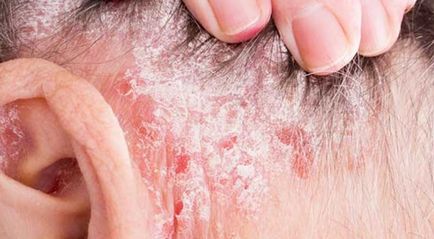 Psoriasis fejbőr tünetek és a kezelés a betegség