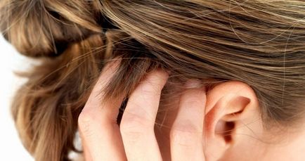 Psoriasis fejbőr tünetek és a kezelés a betegség