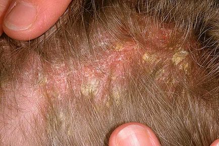 Psoriazisul simptomelor scalpului și metodele de tratare a bolii