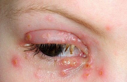 Buborékok a szemhéjak és a szem kialakulásához vezet kezelési módszerek (allergia) Buborékok a szemhéjon szemét oka az oktatás és kezelési módszerek
