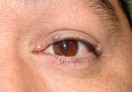 Бульбашки на століттях очей причини утворення та способи лікування