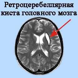 Ретроцеребеллярних кіста головного мозку лікування і наслідки