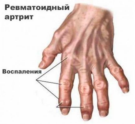 A rheumatoid arthritis kezelése az orvosi és népi jogorvoslati