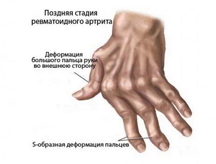 A rheumatoid arthritis kezelése az orvosi és népi jogorvoslati