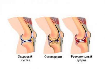 Tratamentul artritei reumatoide prin remedieri medicale și folclorice