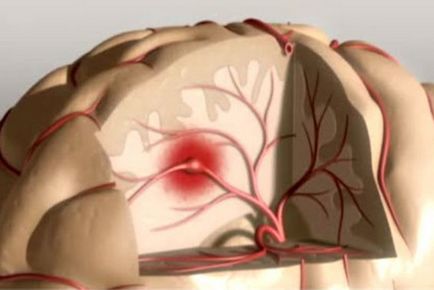 Diabetes mellitus și accident vascular cerebral