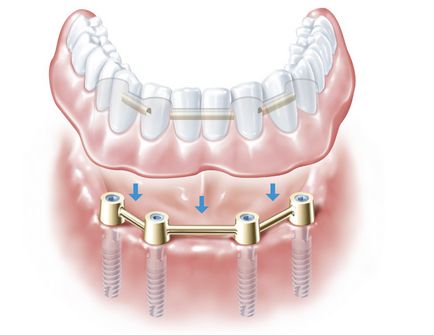 Proteze dentare - clinica dentară privată dali-dent