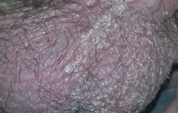 Scalp pielea pe cauzele testiculelor, tratamentul, creșterile pe piele