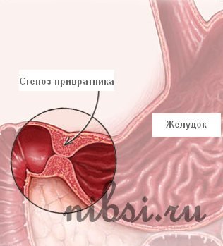 Stenoza sticloasă