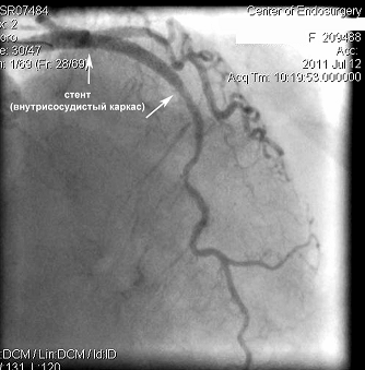 Stentul ca o alternativă deplină la tratamentul chirurgical pentru pacienții cu ischemie