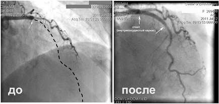 Stentul ca o alternativă deplină la tratamentul chirurgical pentru pacienții cu ischemie