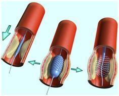 A koszorúér-stent beültetést (műtét után) A koszorúér-stent beültetést