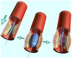 Stentul arterei coronare