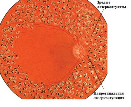 Tromboza venei centrale a retinei Microchirurgia ochiului lui Fedorov.