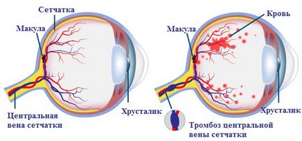 központi retina véna trombózis Szemmikrosebészet szem Fedorova