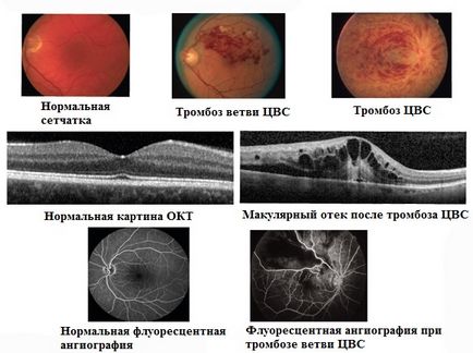 központi retina véna trombózis Szemmikrosebészet szem Fedorova