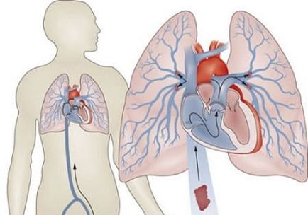 Trombus în simptomele arterei carotide, tratament, prognostic