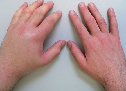 Încheierea tratamentului la încheietura mâinii, simptomele și primul ajutor