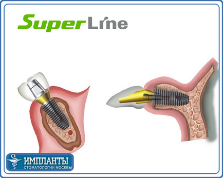 Telepítse a fogászati ​​implantátumok Superline (USA) - implantáció implantátum superlayn szájsebész