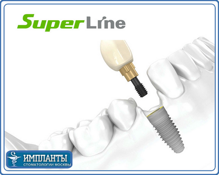 Pentru instalarea implanturilor dentare superline (usa) - implantarea de implanturi de supralina de catre un chirurg stomatolog