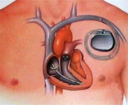 Instalarea unui stimulator cardiac, Dr. Rossso
