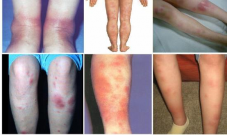 Nodosum az alsó végtagok erythema okok, tünetek, kezelés