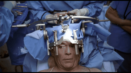 Види операцій при пухлинах головного мозку