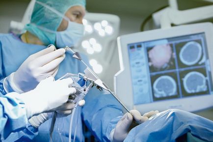 Види операцій при пухлинах головного мозку