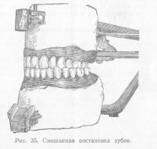 Види постановки зубів, ортопедична стоматологія