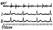 Blocul atrial, aritmii cardiace