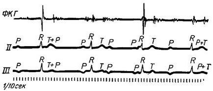 Blocul atrial, aritmii cardiace